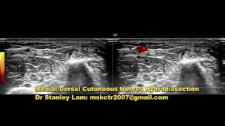 Copy of MSK US Guided Medial Dorsal Cutaneous Nerves Hydrodissection [upl. by Aidam9]