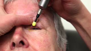 Blepharitis Treatment That Really Works Blephex Eyelid Cleaning [upl. by Goulette]