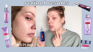 Over 30 Days Of Retinol LOréal Revitalift Skincare Review  heidismakeup [upl. by Robins129]