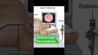 Endoscopy Procedure nandanio4t [upl. by Weinert111]