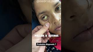 Pallor and icterus are seen mbbsstudent medicalcollegestudents youtubeshorts [upl. by Blayne111]