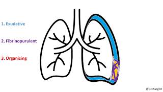 Empyema and Pleural Effusions [upl. by Aihpled312]