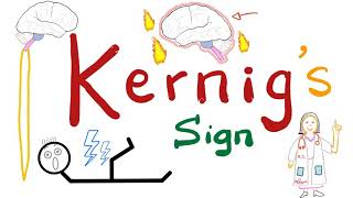 Kernig Sign  Meningitis  Neurology Physical Exam [upl. by Lered176]