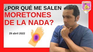 🔴Te interesa🔴 CONOCE las 7️⃣ CAUSAS por las que te salen MORETONES 🟣 [upl. by Noemi209]