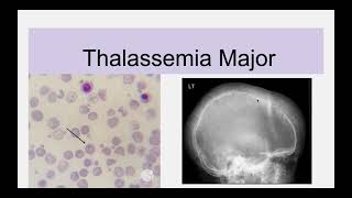 Beta Thalassemia [upl. by Gyatt]