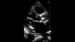 Aortic Stenosis – Ultrasound Image Interpretation [upl. by Atnoed]