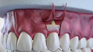 Subepithelial Connective Tissue Grafting [upl. by Merth]