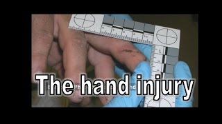 Steven Avery Hand Injury Trial Evidence  Making a Murderer [upl. by Juback]