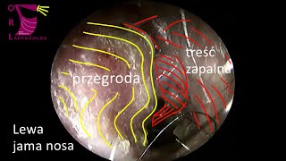 Co się stanie jeśli nie będziesz leczył zapalenia zatok  widok endoskopowy [upl. by Ydnak]