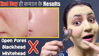 Skin Transformation Challenge Day 2  Remove Open Pores Blackhead Whitehead Naturally in 5 Days💕 [upl. by Damas]