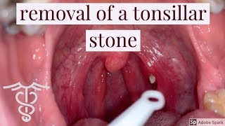 Removal of a tonsillar stone  patient education video by Dr Carlo Oller [upl. by Bevus]