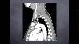 Parathyroid CT Scanning [upl. by Alessandro]