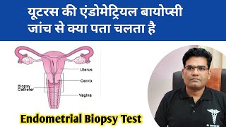 Endometrial Biopsy Use  Endometrial Cancer Test  यूटरस की बायोप्सी जाँच क्यूँ करवायीं जाती है [upl. by Winnie133]