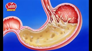 Cette bactérie vous empêche de perdre des kilos Voici comment vous en débarrasser et perdre 10 kilo [upl. by Lustick136]