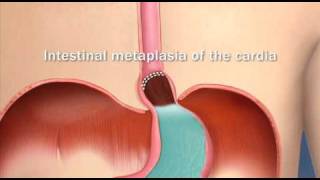 Barretts Esophagus Intestinal Metaplasia of the CardiaMayo Clinic [upl. by Benjie]