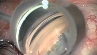 Combined Cataract Procedure with iStent Glaucoma Implant [upl. by Mahala]