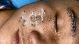 Hormonal Acne nodule or inflamed abscessed cyst You be the judge Contents under pressure [upl. by Bethanne555]