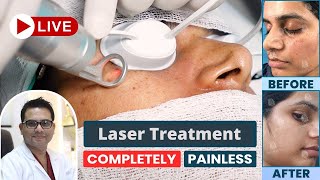 Freckles Laser Treatment  Best Freckles Laser Treatment in Delhi NCR  SkinQure  Dr Jangid [upl. by Lovering]