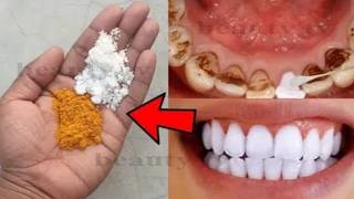 Whiten Teeth in 3 Minutes Quick Home Remedy [upl. by Lanza]