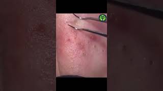 Nose Blackhead Removal  Watch the Deep Extraction shorts viral blackheadremoval [upl. by Yeldud417]