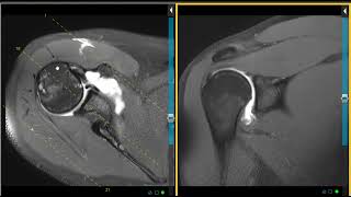 Labral tears and shoulder instability in twin brothers [upl. by Durwin]