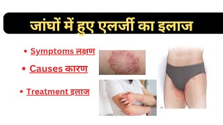 दाद खाज खुजली की दवा।।treatment on skin infection।।medicin [upl. by Beeck]