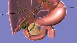 Your Biliary Drain [upl. by Llenod728]