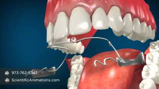 Jaw Surgery for Teeth Alignment  Fixing Jaw Braces [upl. by Dareece373]