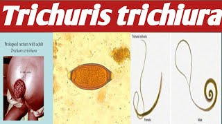 Trichuris trichiura  Ahmaric Tutorial [upl. by Clevey233]