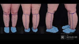 What is Lipedema [upl. by Craw]