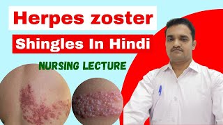 herpes zoster skin disease  shingles  symptoms treatmentcare  herpes skin disease [upl. by Ahsiner763]