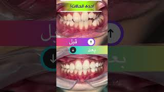 Best time for putting Braces for your child  شو أفضل وقت لبدأ تقويم الأسنان لطفلك ؟ [upl. by Nnauol]