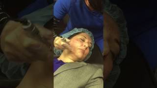 MesoPen MicroNeedling Treatment [upl. by Nerol]