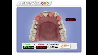 Spacewize Dental Crowding Calculator [upl. by Lerim882]