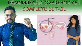 HEMORRHAGIC OVARIAN CYST Treatment [upl. by Horacio]