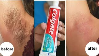 How to epilate face body and intimate areas painlessly and without razor effective 💯 [upl. by Koerner251]