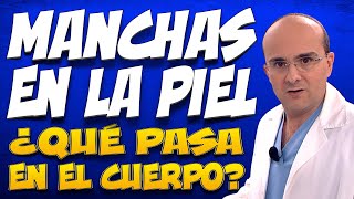 MANCHAS EN LA PIEL  ¿Qué pasa dentro del cuerpo de las personas que las padecen [upl. by Leik]