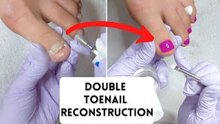 Double Toenail Reconstruction With LCN Barefoot Gel And Gehwol Nail Repair Gel [upl. by Oesile763]