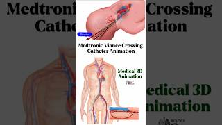 Medtronic Viance Crossing Catheter Cardiovascular Animation medical animation 3d short [upl. by Euh]