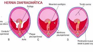 3 RM19 2V CIRUGÍA PEDIÁTRICA QUISTE COLÉDOCO ATRESIA VIAS B HERNIA DIAFRAGM [upl. by Lleumas]