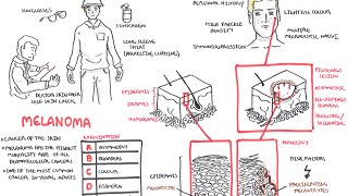 Melanoma  Overview signs and symptoms pathology risk factors treatment [upl. by Mistrot]