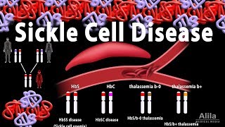 Sickle Cell Disease Animation [upl. by Cecilia632]