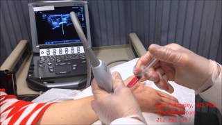 Neural Prolotherapy for Carpal Tunnel Syndrome at NYC [upl. by Bridie]