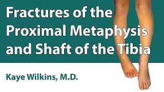 Fractures Of The Proximal Metaphysis amp Shaft Of The Tibia [upl. by Ynnot44]