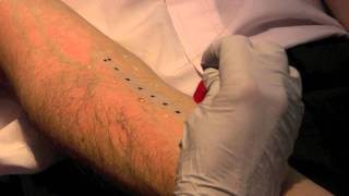 Skin Prick Allergy Test [upl. by Eniarda]