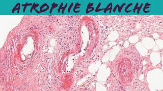 Atrophie blanche livedoid vasculopathy dermatology dermpath pathology [upl. by Kir]