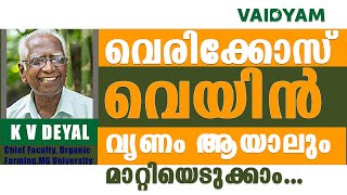 വെരിക്കോസ് വെയിൻ വൃണം ആയാലും മാറ്റിയെടുക്കാം NaturalAyurvedic Treatment Varicose Veins kvdayal [upl. by Asiret]