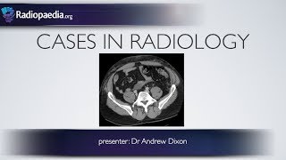 Cases in Radiology Episode 5 trauma CT abdomen [upl. by Katlaps]