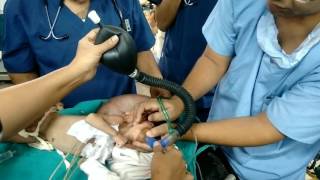 Difficult intubation in 3 months old baby with a large encephalocele [upl. by Githens]