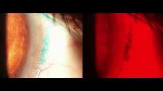 11 Slit Lamp Techniques Lissamine Green HD [upl. by Filomena]